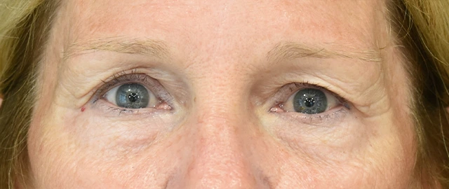 Eyelid Surgery Patient 25 Set 1 Before