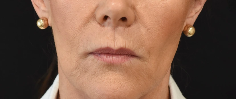 Lip Lift Patient 9 Set 1 After